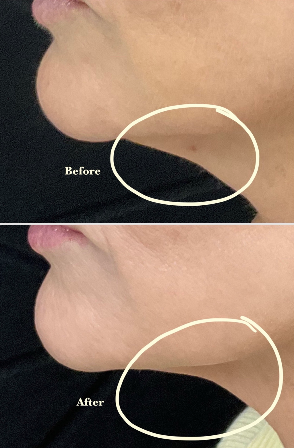 bpc 157 skin tightening Best Shockwave Therapy for Skin Tightening Walnut Creek, CA